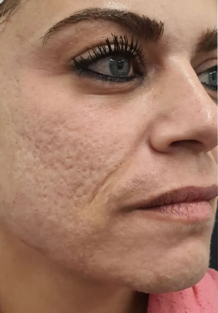 EraPeel