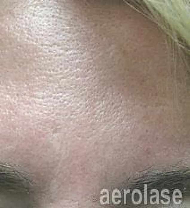 EraPeel