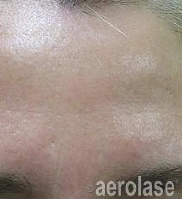 EraPeel