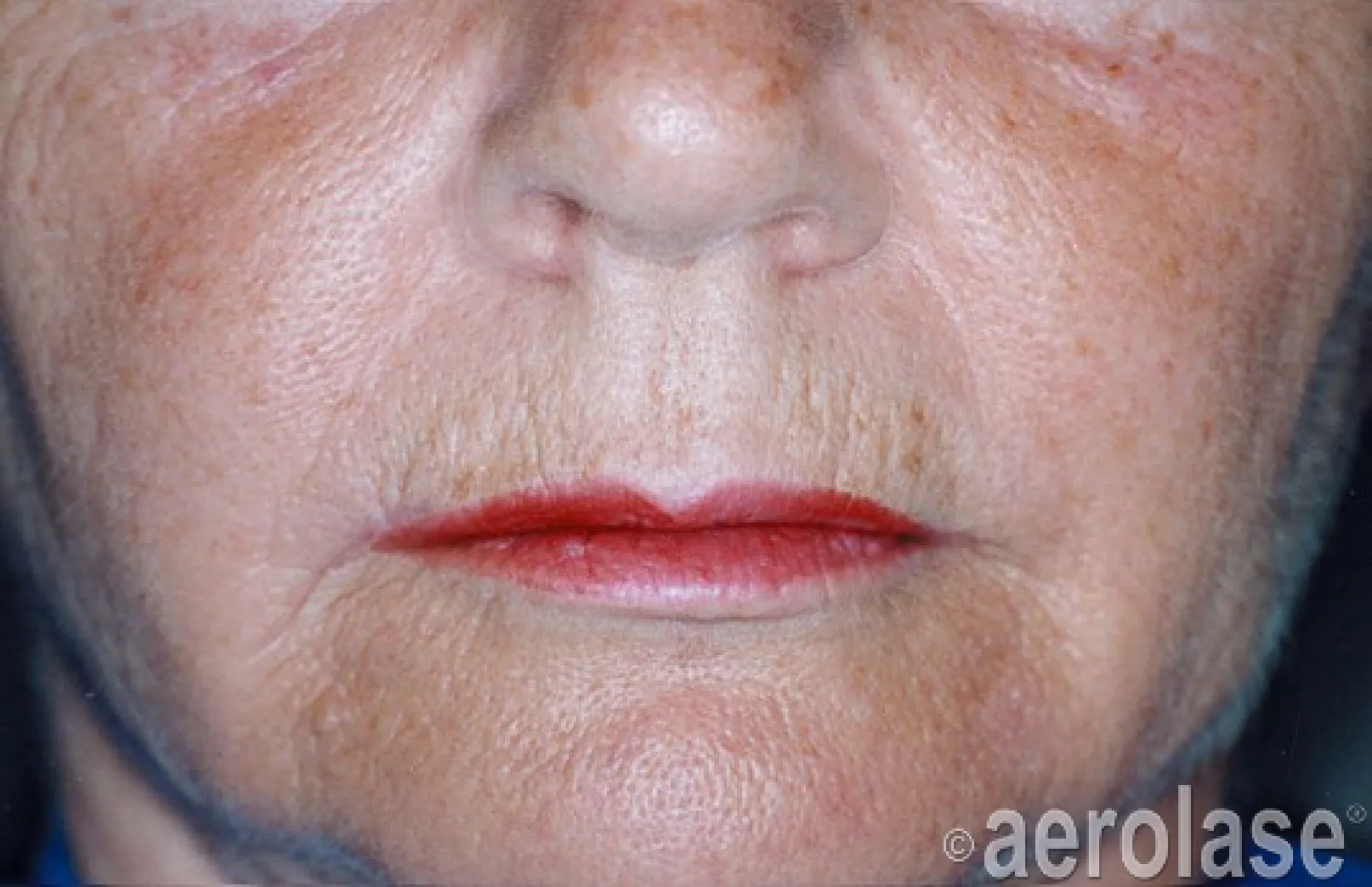 EraPeel