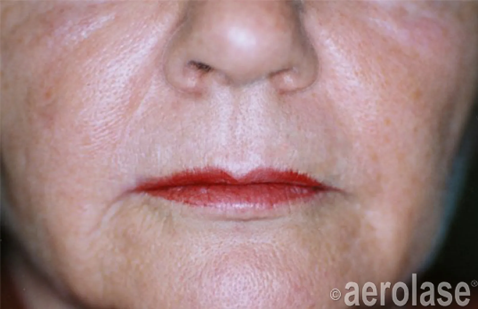 EraPeel