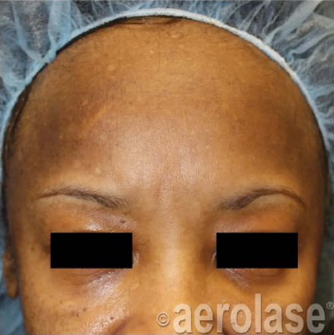 Melasma