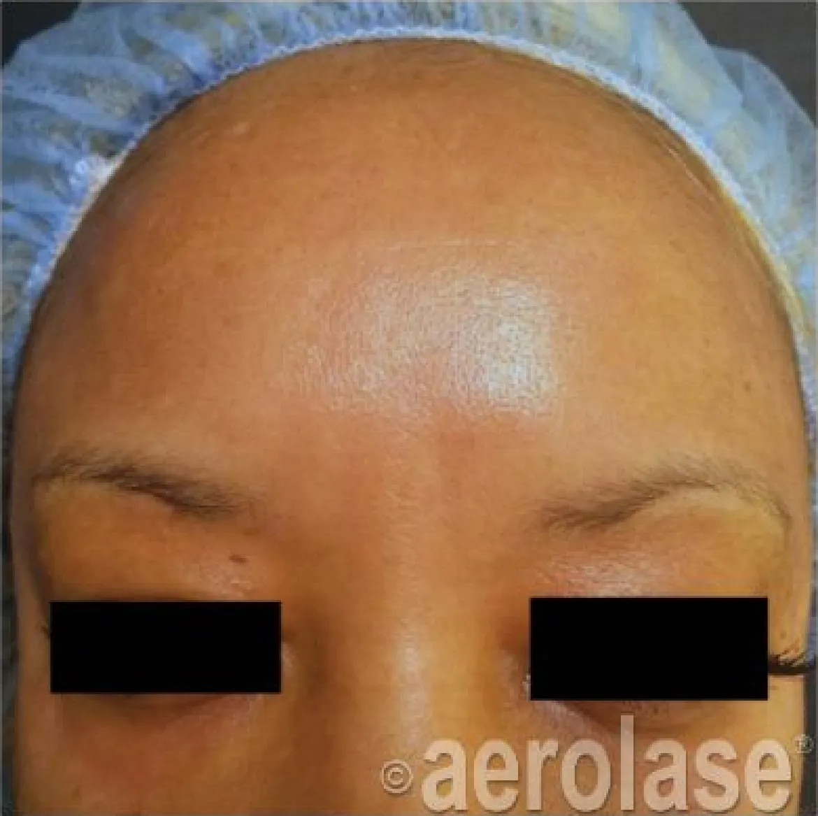 Melasma