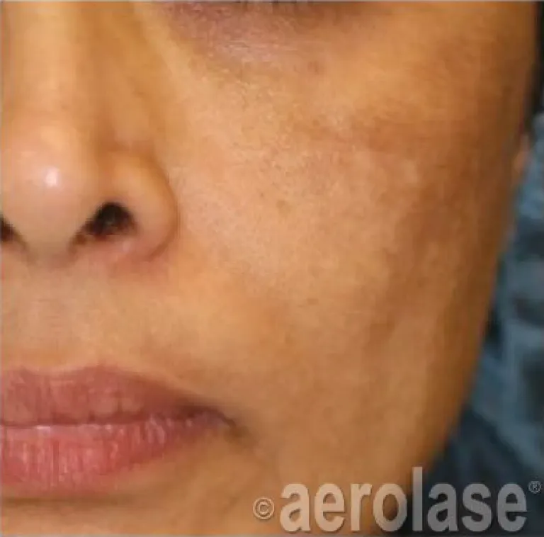 Melasma