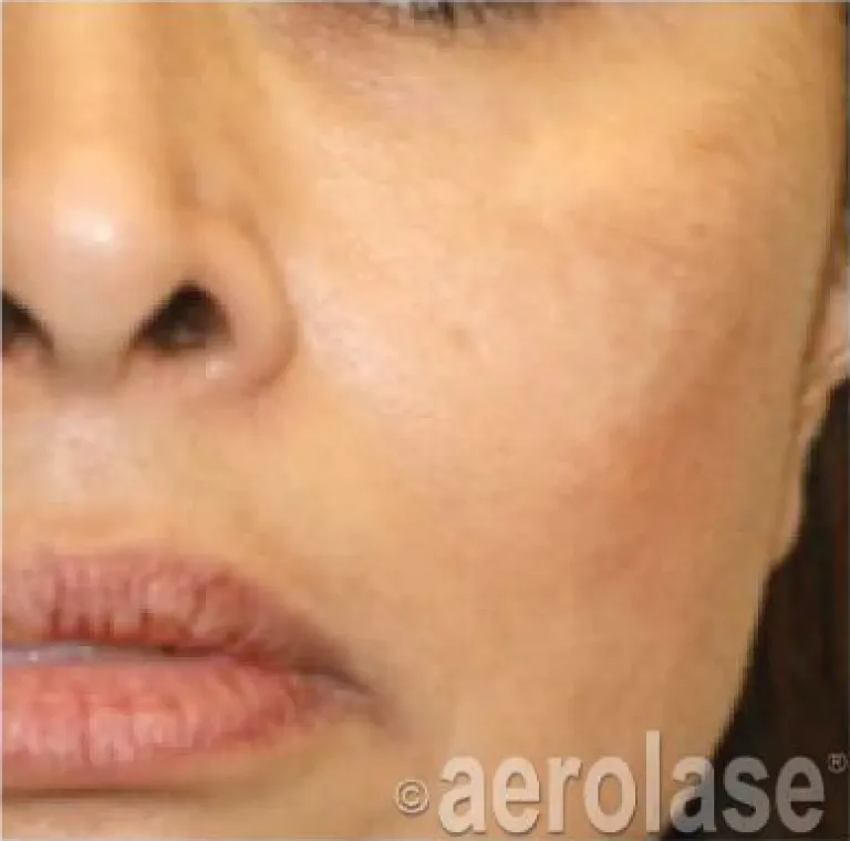 Melasma
