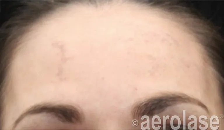 Melasma