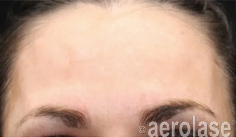 Melasma