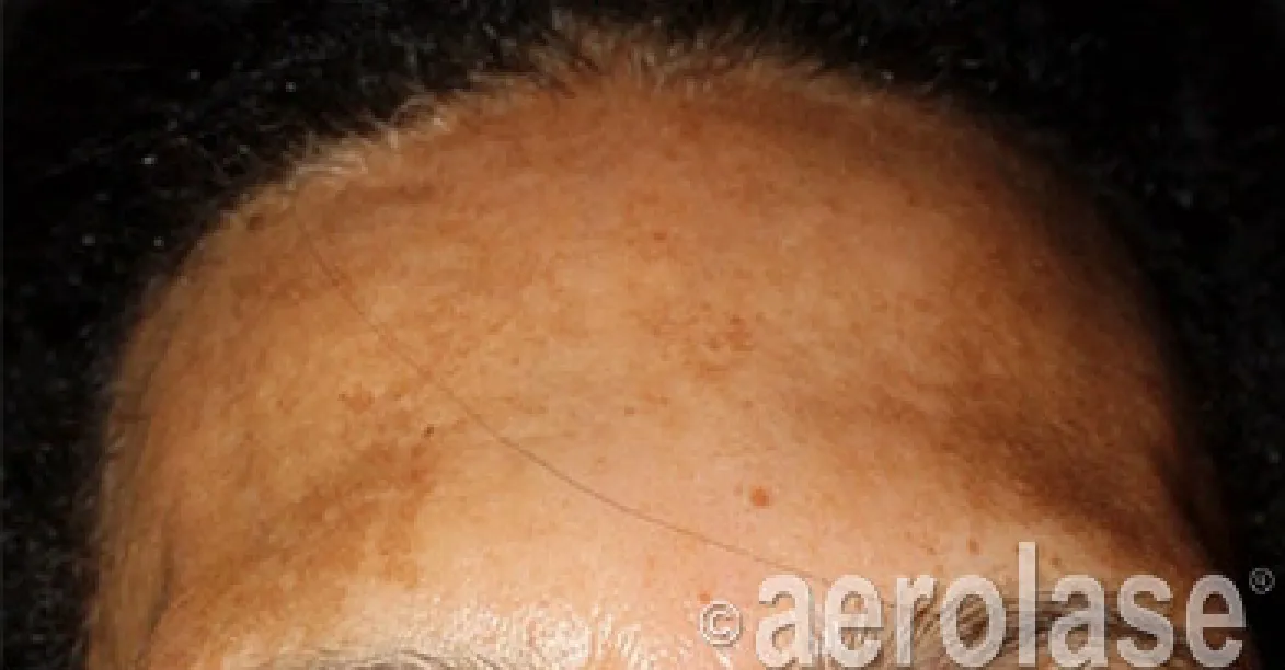 Melasma