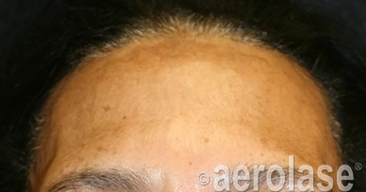Melasma