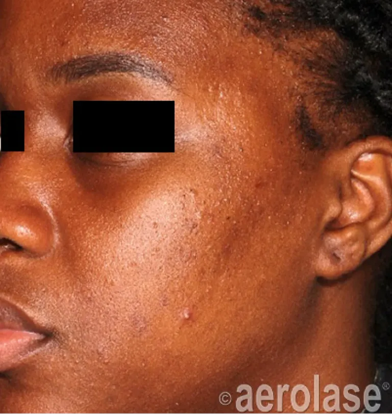 Acne