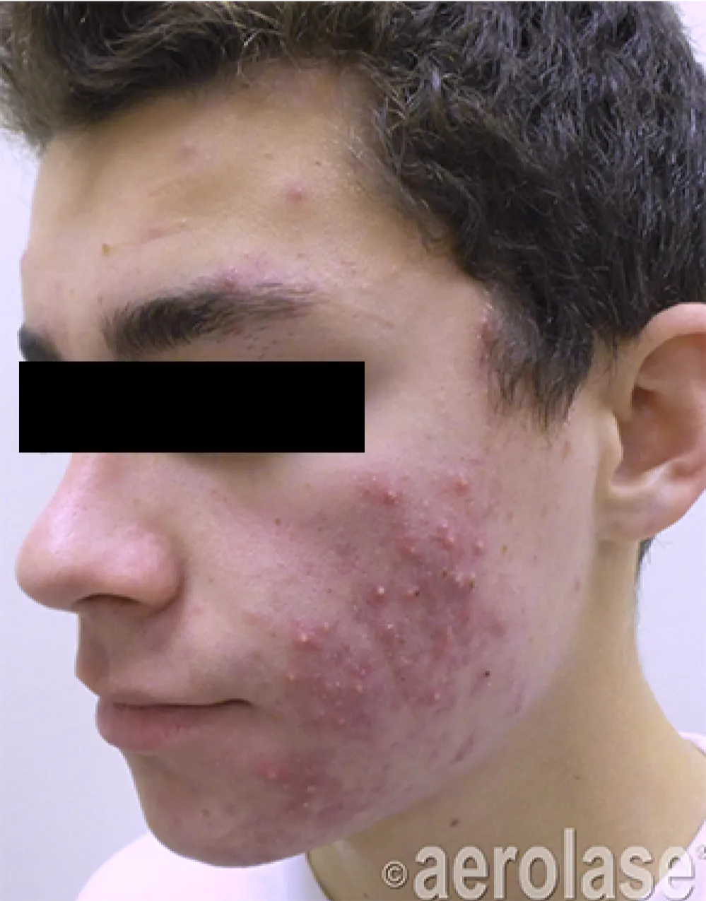 Acne