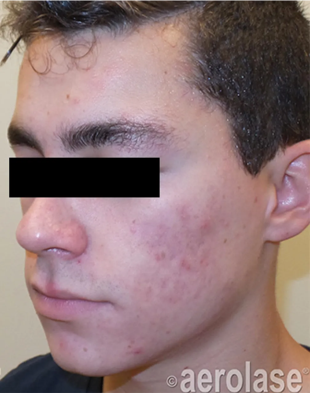 Acne