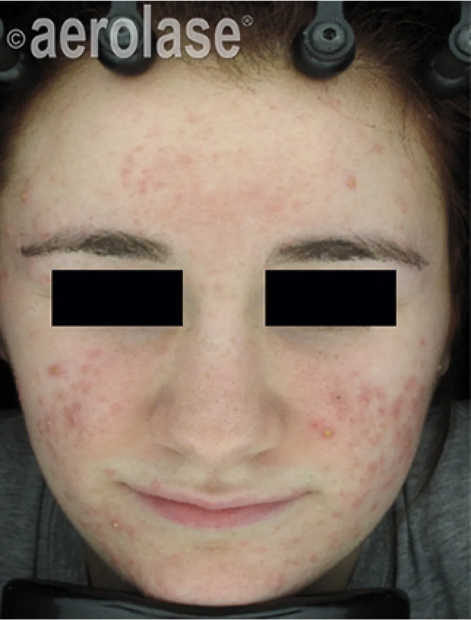 Acne